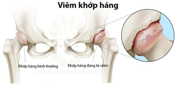 Viêm khớp háng