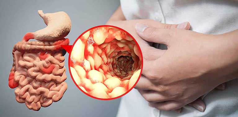 bệnh Crohn là bệnh về đại tràng thường gặp