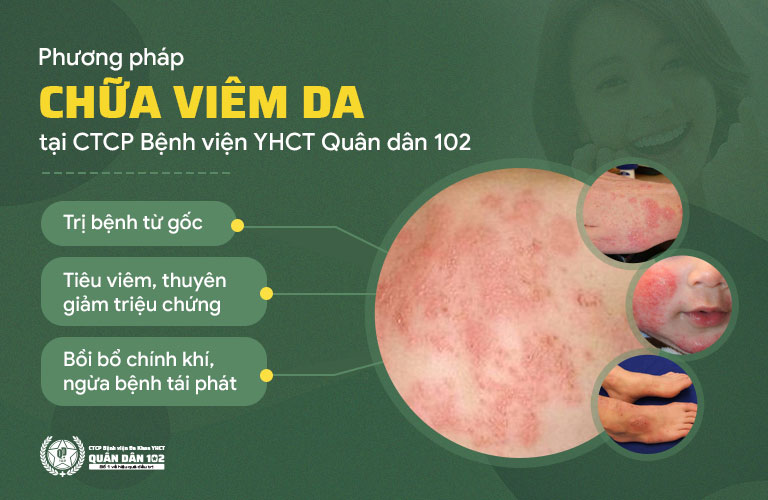 Quân dân 102 là một trong những đơn vị có quy trình xử lý bệnh viêm da tốt nhất hiện nay