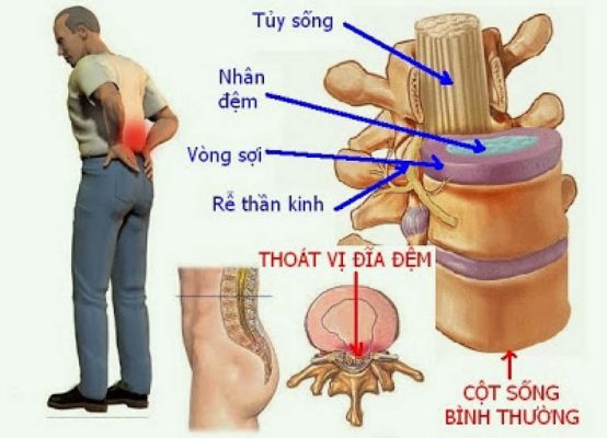 Thoát vị đĩa đệm