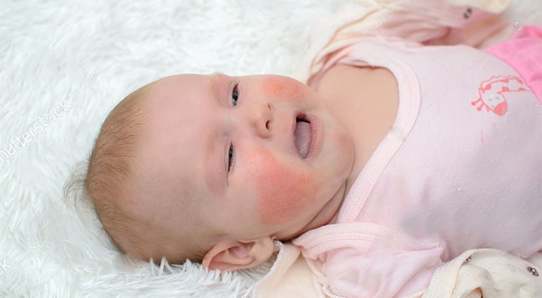 Bé Na có những biểu hiện viêm da cơ địa khi 11 tháng tuổi