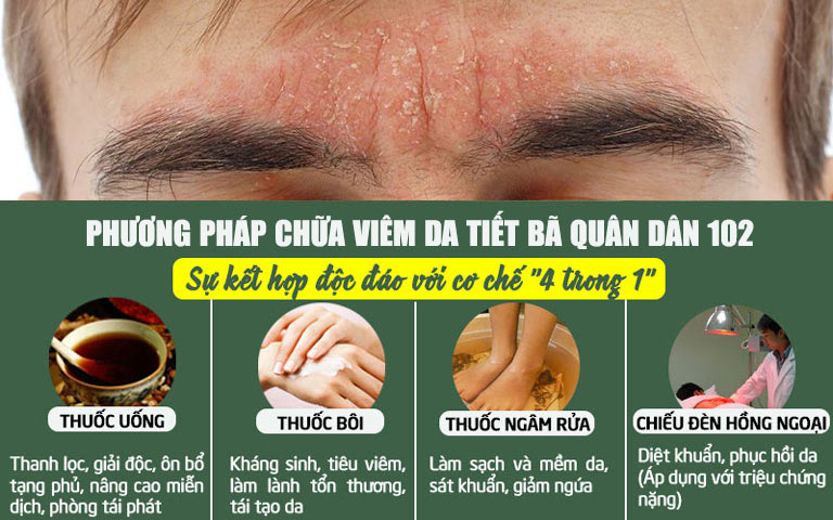 Liệu trình bài thuốc viêm da tiết bã Quân dân 102 có công thức kết hợp vô cùng độc đáo, toàn diện