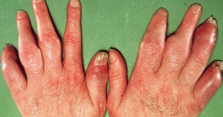 viêm khớp ngón tay là gì