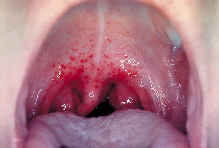 Viêm họng hạt là tình trạng viêm nhiễm ở hầu họng với sự xuất hiện của các hạt li ti màu đỏ trên thành họng