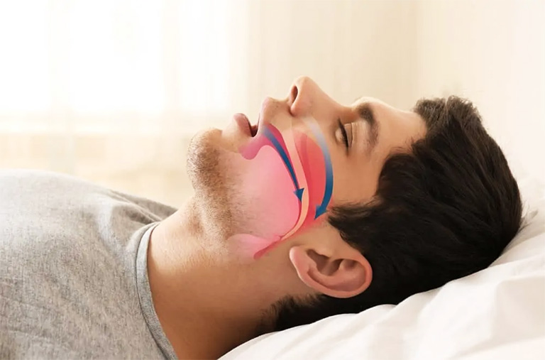 Người bệnh còn có nguy cơ gặp hội chứng ngưng thở khi ngủ nếu tình trạng viêm nhiễm amidan diễn tiến nặng
