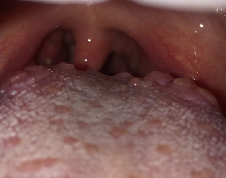 Viêm họng hạt ở lưỡi