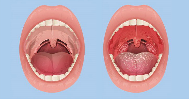 Viêm họng hạt ở lưỡi