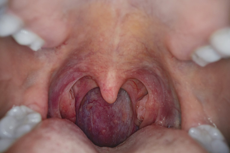 viêm họng mãn tính có phát triển thành ung thư không?