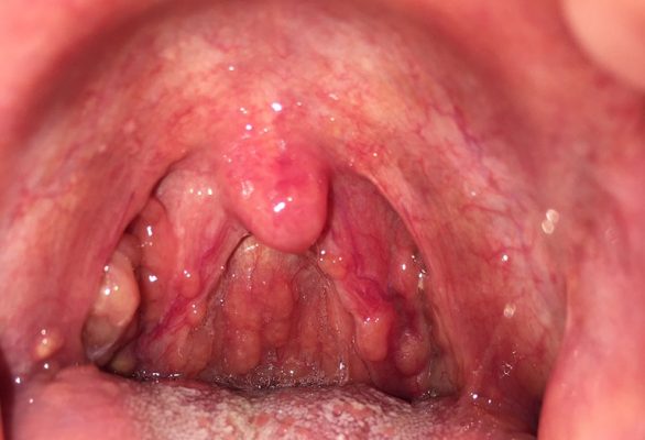 Viêm họng xuất tiết
