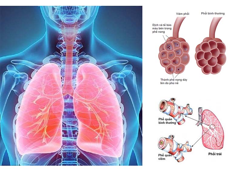 Viêm phổi và viêm phế quản