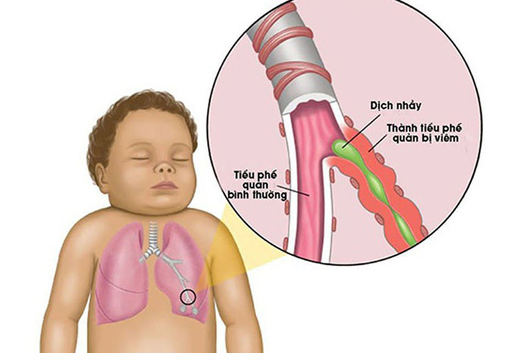 viêm tiểu phế quản ở trẻ ở sinh