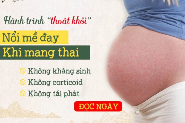 Chữa mề đay khi mang thai tại Quân dân 102