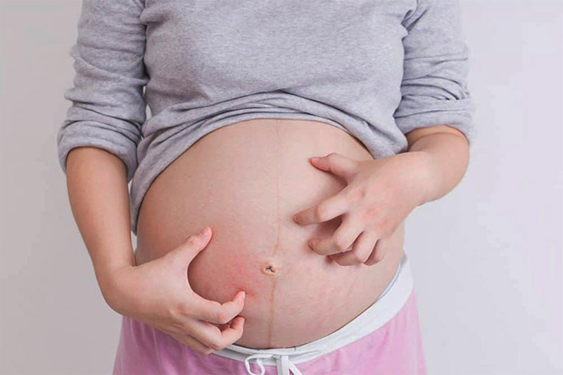 Nổi mề đay khi mang thai gây ra nhiều khó chịu, bất tiện trong cuộc sống, sinh hoạt