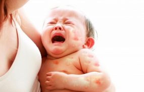 Mề đay ở trẻ em khiến bé quấy khóc, chán ăn, mất ngủ, chậm phát triển