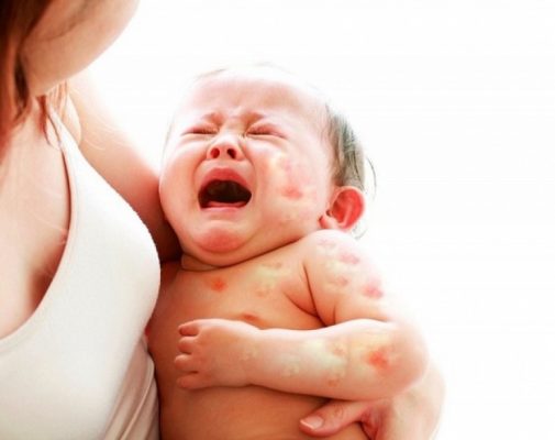 Mề đay ở trẻ em khiến bé quấy khóc, chán ăn, mất ngủ, chậm phát triển