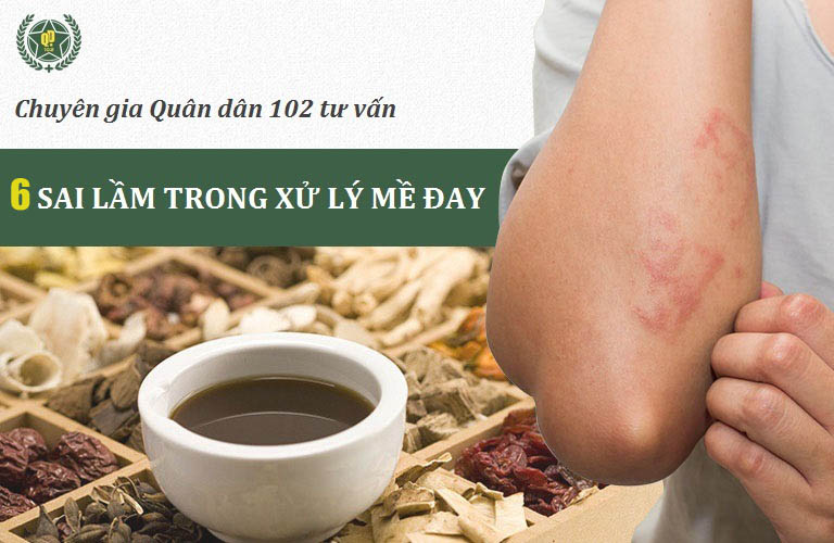 Để tránh mắc mề đay mãn tính, người bệnh cần chăm sóc đúng cách, hạn chế mắc phải 5 sai lầm sau