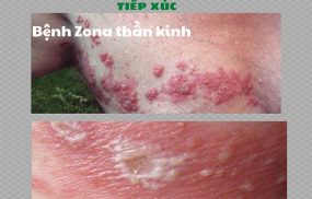 phân biệt bệnh Zona và viêm da tiếp xúc