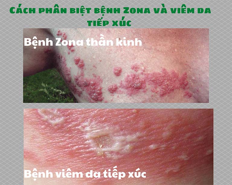 phân biệt bệnh Zona và viêm da tiếp xúc