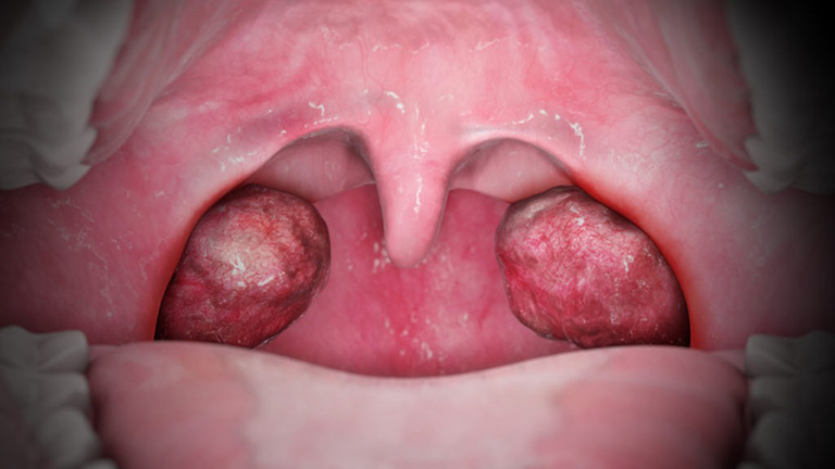 Viêm amidan là tình trạng viêm nhiễm xảy ra tại khối lympho ở hầu họng do tình trạng tấn công quá mức của vi khuẩn, virus hay nấm