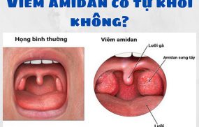 Viêm amidan có tự khỏi không?