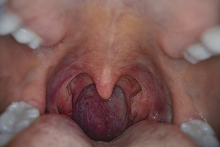 Mặc dù khả năng bệnh viêm amidan hốc mủ bã đậu chuyển sang ung thư vòm họng là khá thấp nhưng người bệnh tuyệt đối không được chủ quan mà cần sớm điều trị