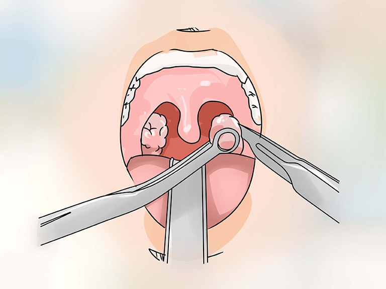 Phẫu thuật cắt bỏ amidan chỉ được chỉ định thực hiện ở một số trường hợp