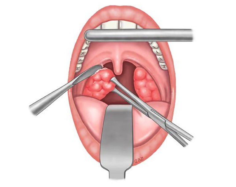 Các trường hợp có khối amidan bị sưng to gây chèn ép nhiều cho đường thở sẽ được bác sĩ cân nhắc điều trị bằng phương pháp phẫu thuật cắt bỏ