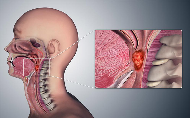 Bị viêm amidan nổi hạch ở cổ có thể là dấu hiệu của bệnh ung thư vòm họng