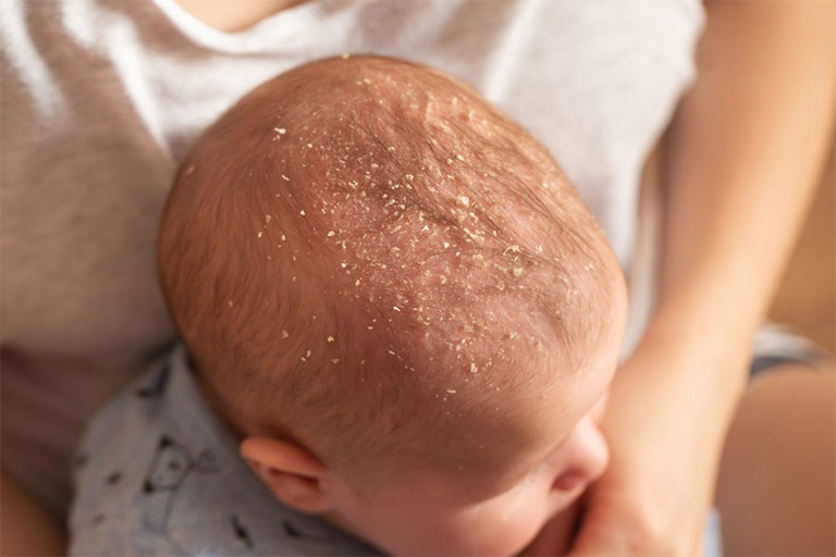 Dấu hiệu nhận biết viêm da tiết bã da đầu ở trẻ nhỏ