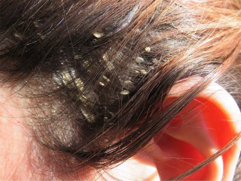 Viêm da tiết bã da đầu là bệnh da liễu mãn tính, có thẻ gặp cả trẻ nhỏ và người lớn