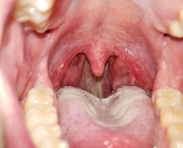 Vì vị trí của amidan nằm gần hầu họng nên khi hầu họng bị viêm nhiễm thì có thể các tác nhân gây hại có thể tấn công và gây viêm, từ đó sinh viêm amidan
