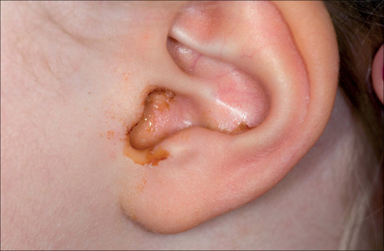 Viêm tai giữa là biến chứng gần của viêm họng hạt mãn tính không được điều trị từ sớm