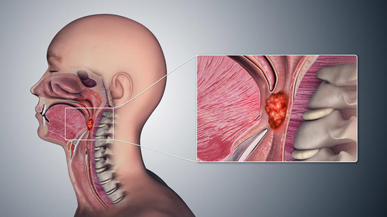Viêm họng hạt mãn tính hoàn toàn có khả năng chuyển tiến triển thành ung thư vòm họng mặc dù tỷ lệ rất thấp