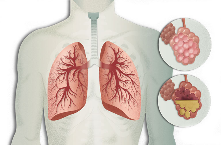 Viêm phổi là căn bệnh gây ra triệu chứng khó thở, thở khò khè và ho khạc đờm có máu