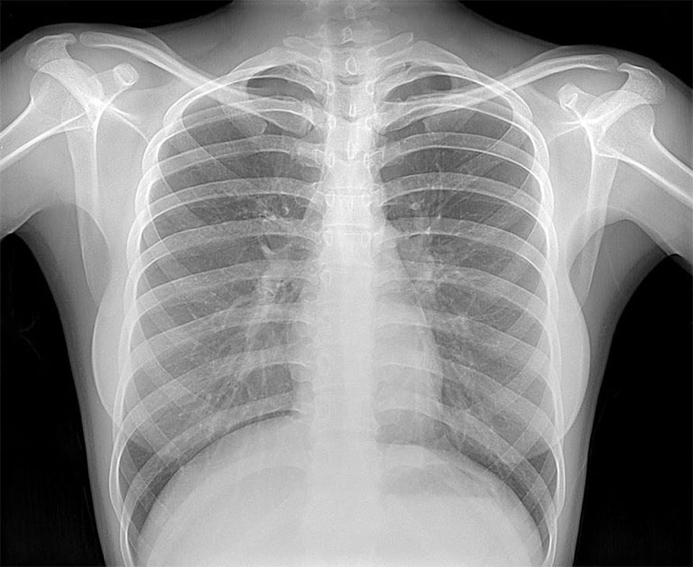 Chụp X - quang lồng ngực tuy không chẩn đoán được tình trạng co thắt nhưng cho phép bác sĩ phát hiện các biểu hiện bất thường ở phổi