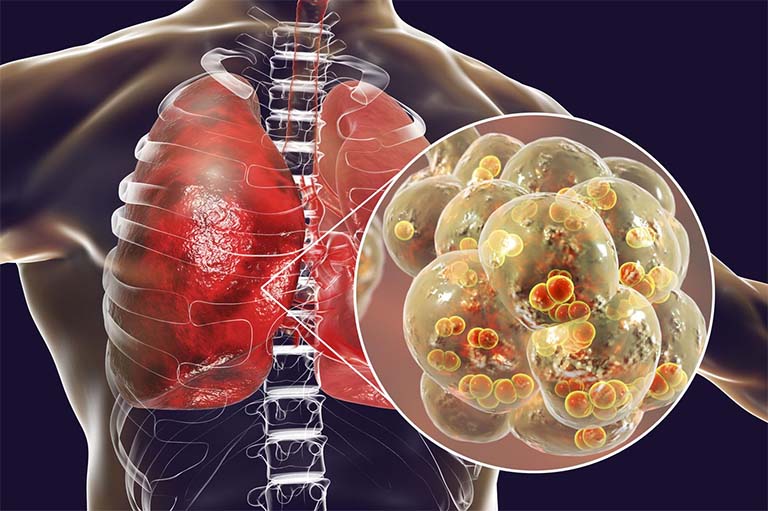 Bệnh viêm thanh khí phế quản cấp có thể gây ra viêm phổi hoặc nhiễm phổi nặng nếu không sớm có biện pháp khắc phục và điều trị
