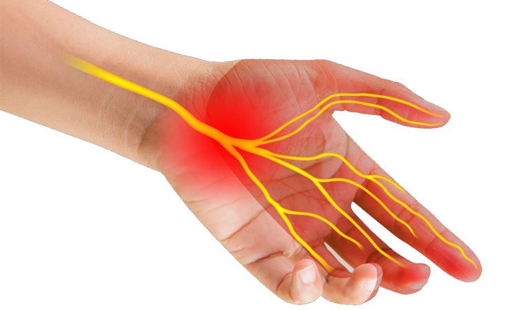 Hội chứng ống cổ tay là một trong những biến chứng của bệnh viêm đa khớp