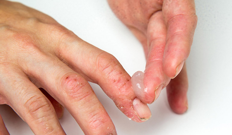 Sử dụng thuốc bôi ngoài da giúp cải thiện nhanh chóng các triệu chứng khó chịu do bệnh gây ra