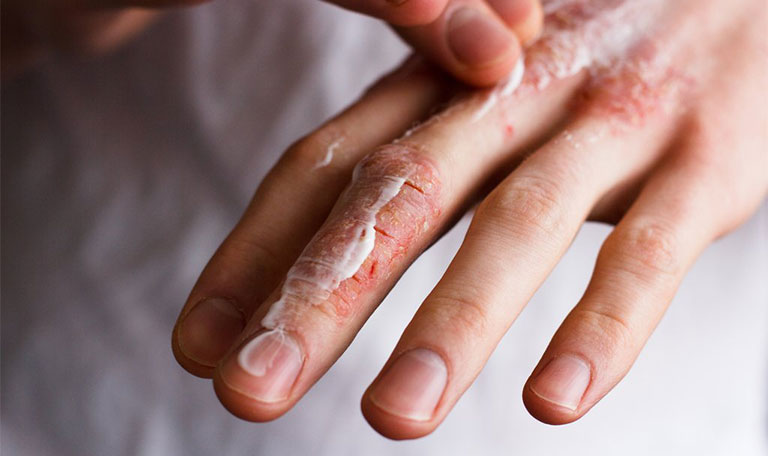 Chú ý dưỡng ẩm và chăm sóc da đúng cách để ngăn ngừa bệnh chuyển biến nặng