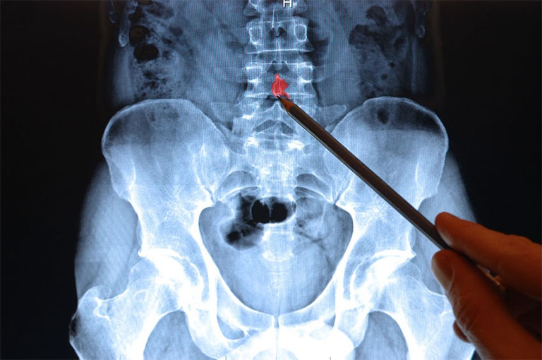 Chụp X-quang là một trong những thủ thuật chẩn đoán thoái hóa cột sống điển hình