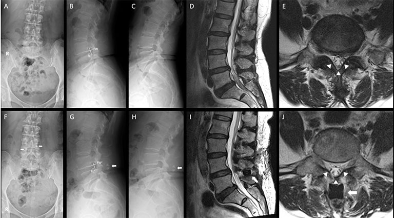 Chụp X-quang, chụp cộng hưởng từ MRI, chụp CT cắt lớp,... là những thủ thuật chẩn đoán bệnh thoát hóa đốt sống lưng L4 L5 điển hình