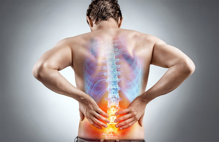 Nhiều người đang thắc mắc thoái hóa cột sống lưng có nguy hiểm không, gây ra biến chứng nào