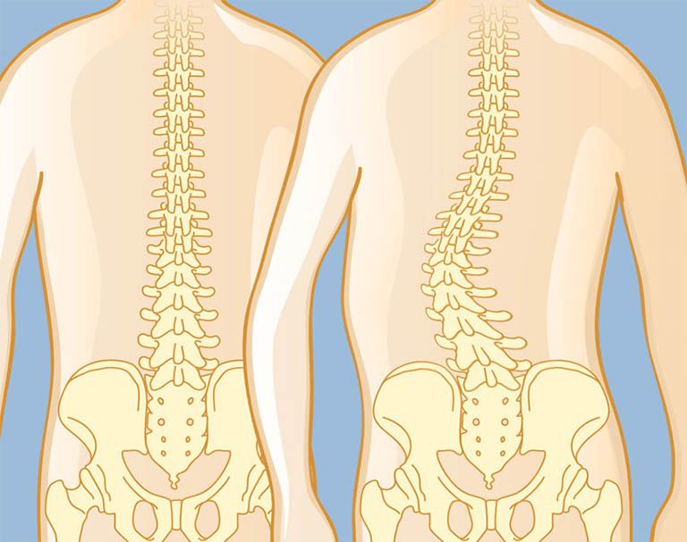 Cơn đau lưng do thoái hóa cột sống lưng gây ra có thể tác động đến cấu trúc của cột sống