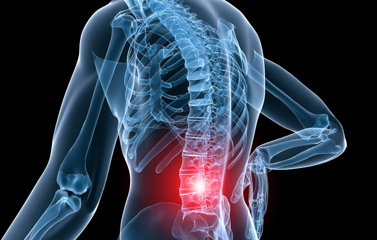 Thoái hóa cột sống thắt lưng là hiện tượng các đốt sống ở vùng thắt lưng bị tổn thương và dần hình thành nên gai xương