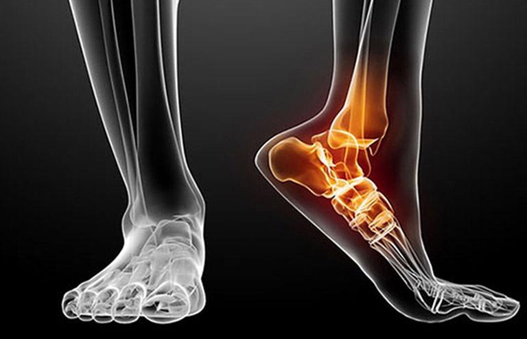 chụp x-quang chẩn đoán thoái hóa khớp cổ chân