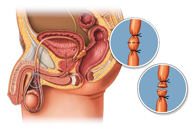 Triệt sản nam được xem là biện pháp tránh thai vĩnh viễn dành cho nam giới bằng cách làm gián đoạn ống dẫn tinh