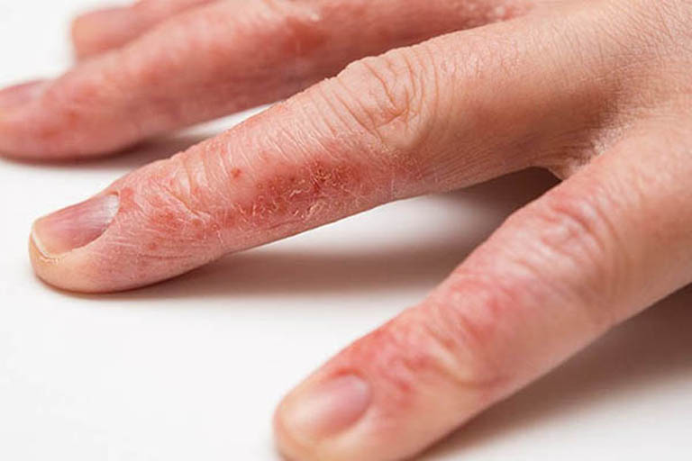 Viêm da đầu ngón tay là bệnh lý về da liễu xảy ra khá phổ biến và gây ảnh hưởng đến chất lượng cuộc sống của người bệnh