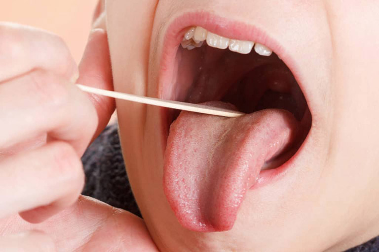 Viêm hầu họng tăng sinh mô hạt xảy ra khi bệnh viêm họng hạt tiến triển sang giai đoạn mãn tính