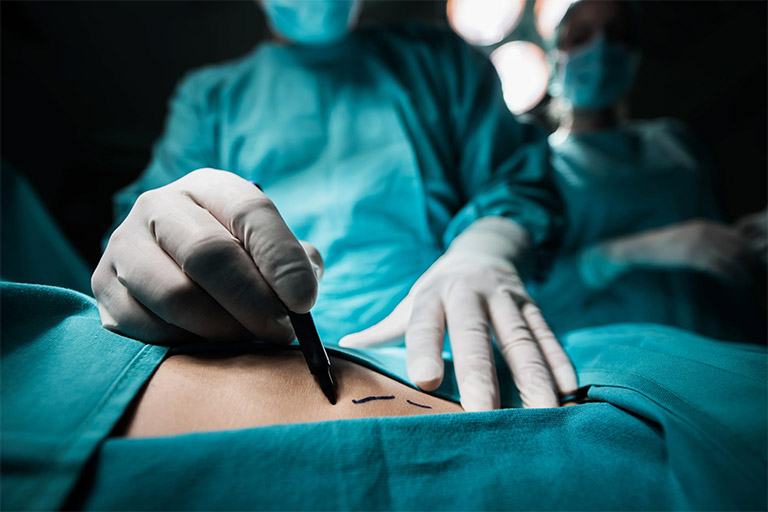 Phẫu thuật là phương pháp điều trị được áp dụng cho các trường hợp dạ dày chảy máu ồ ạt hay xuất hiện biến chứng nguy hiểm