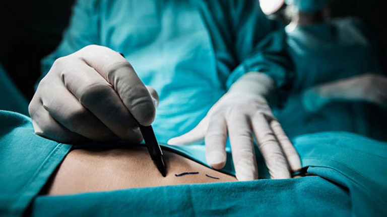 Phẫu thuật cắt túi mật để chữa sỏi mật đối với trường hợp bệnh nặng, kích thước sỏi lớn